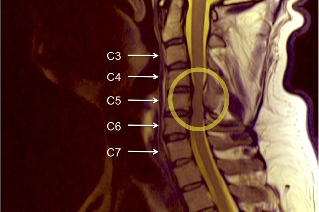 mielopatia-cervical-estenose-cervical-vertebral-rs