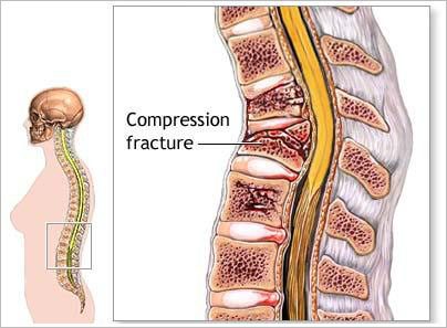 1920-20trauma20na20coluna20vertebral202-5269400